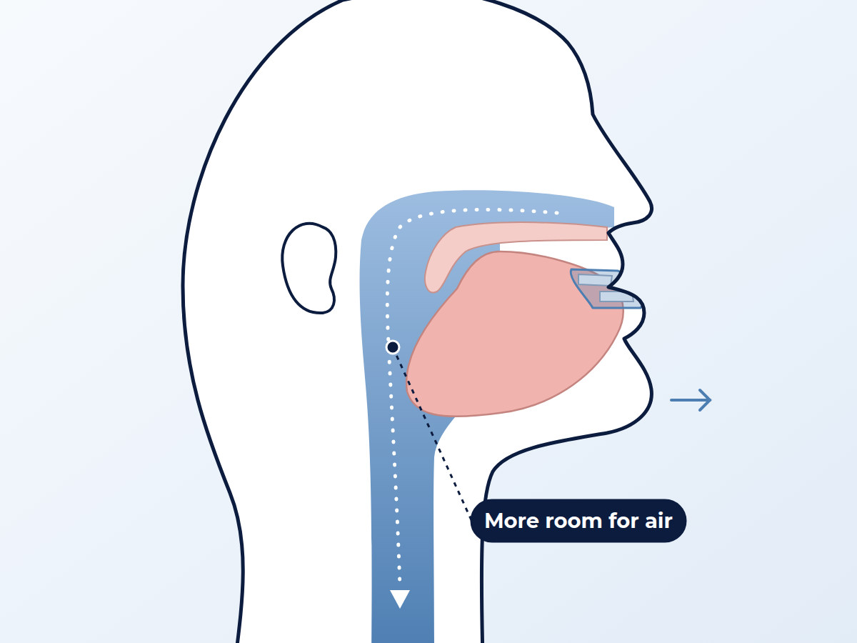 Jaw forward